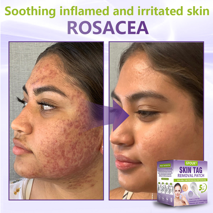 Dissolvable Botanical Microneedle Patch for Skin Tag and Mole Removal 🌴🌴 — Removes lesions in just 5 days, painlessly and scar-free