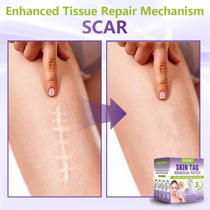 Dissolvable Botanical Microneedle Patch for Skin Tag and Mole Removal 🌴🌴 — Removes lesions in just 5 days, painlessly and scar-free