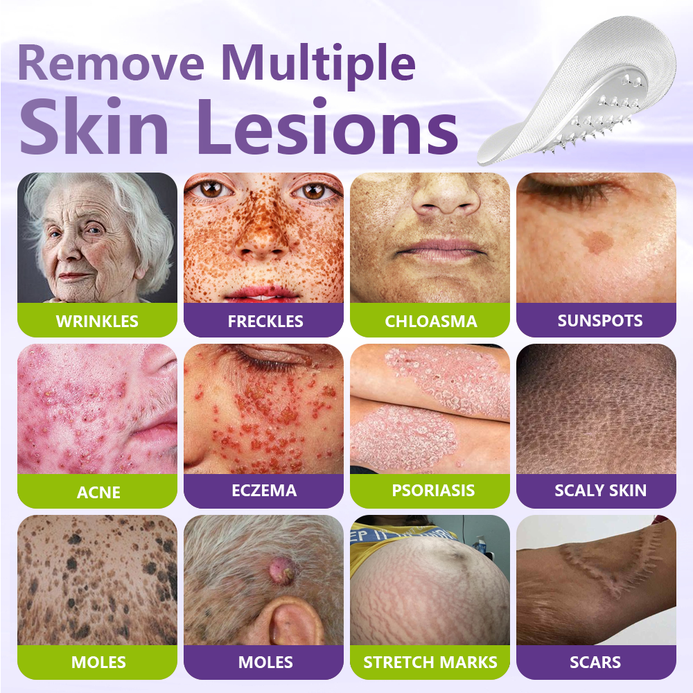 Dissolvable Botanical Microneedle Patch for Skin Tag and Mole Removal 🌴🌴 — Removes lesions in just 5 days, painlessly and scar-free