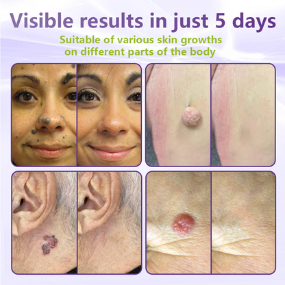 Dissolvable Botanical Microneedle Patch for Skin Tag and Mole Removal 🌴🌴 — Removes lesions in just 5 days, painlessly and scar-free