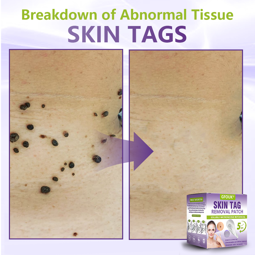 Dissolvable Botanical Microneedle Patch for Skin Tag and Mole Removal 🌴🌴 — Removes lesions in just 5 days, painlessly and scar-free