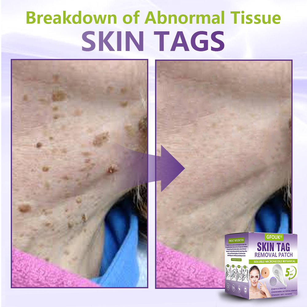 Dissolvable Botanical Microneedle Patch for Skin Tag and Mole Removal 🌴🌴 — Removes lesions in just 5 days, painlessly and scar-free