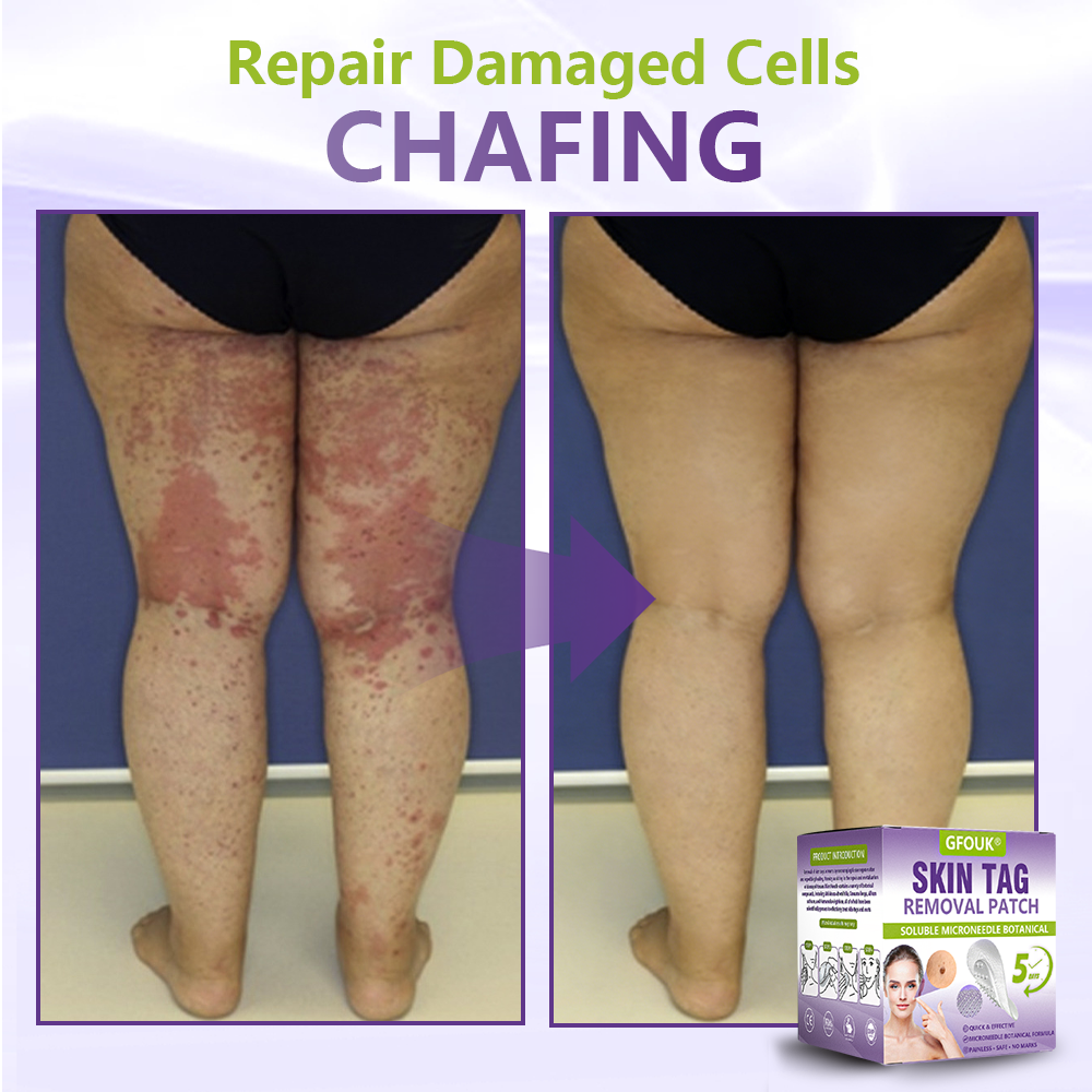 Dissolvable Botanical Microneedle Patch for Skin Tag and Mole Removal 🌴🌴 — Removes lesions in just 5 days, painlessly and scar-free