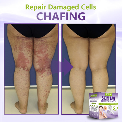 Dissolvable Botanical Microneedle Patch for Skin Tag and Mole Removal 🌴🌴 — Removes lesions in just 5 days, painlessly and scar-free