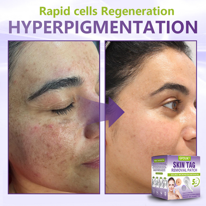 Dissolvable Botanical Microneedle Patch for Skin Tag and Mole Removal 🌴🌴 — Removes lesions in just 5 days, painlessly and scar-free