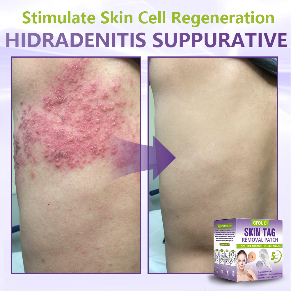Dissolvable Botanical Microneedle Patch for Skin Tag and Mole Removal 🌴🌴 — Removes lesions in just 5 days, painlessly and scar-free