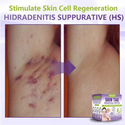Dissolvable Botanical Microneedle Patch for Skin Tag and Mole Removal 🌴🌴 — Removes lesions in just 5 days, painlessly and scar-free