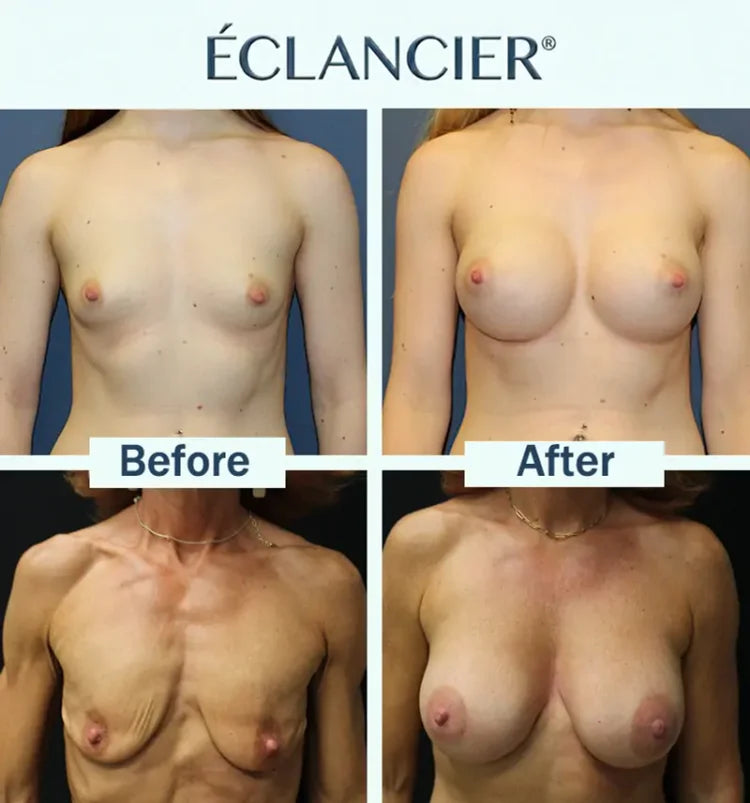 ÉCLANCIER® PRO Targeted Breast Enhancement Advanced Nano Microneedle Patch